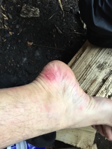 Blisters aren't too fun